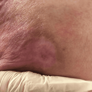 Bed sores are a sign of neglect at a nursing home. 